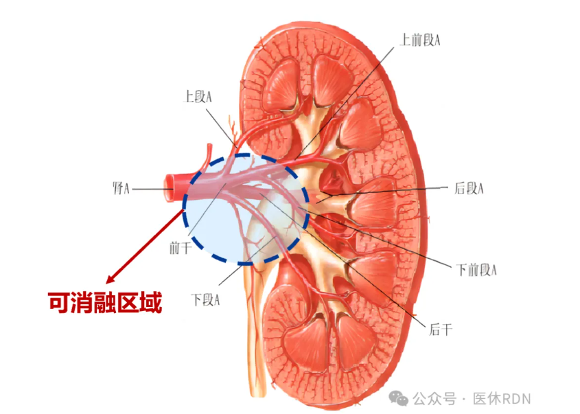 收藏！RDN一般手术操作步骤