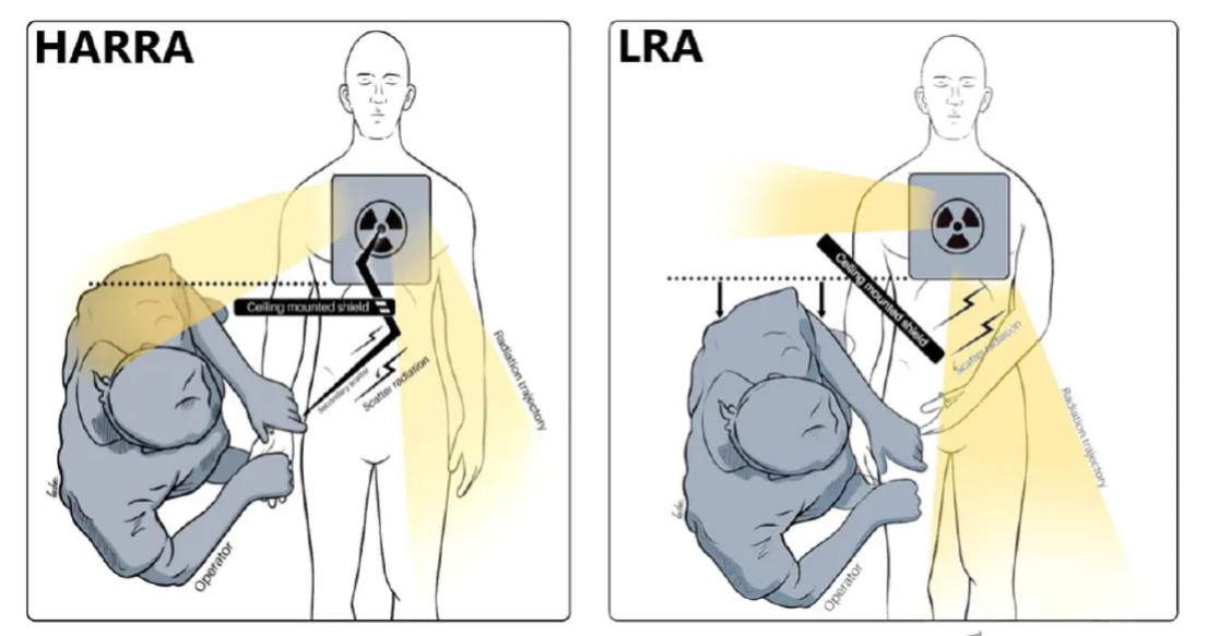 研究发现：左桡入路（LRA）可显著降低术者辐射暴露